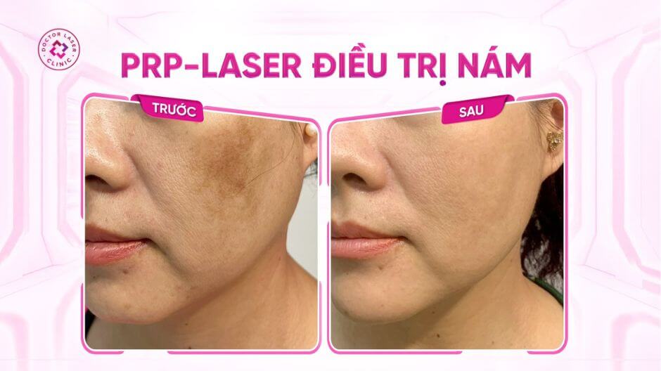 trước sau điều trị nám prp kết hợp laser pico