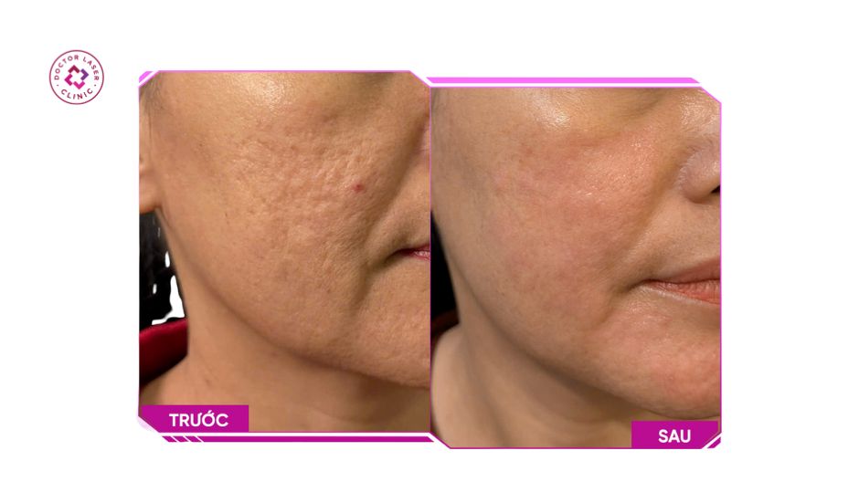 trước sau điều trị sẹo rỗ lâu năm