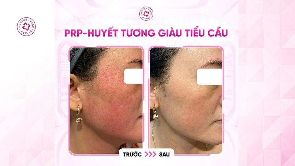 trước sau prp theo dõi phục hồi da