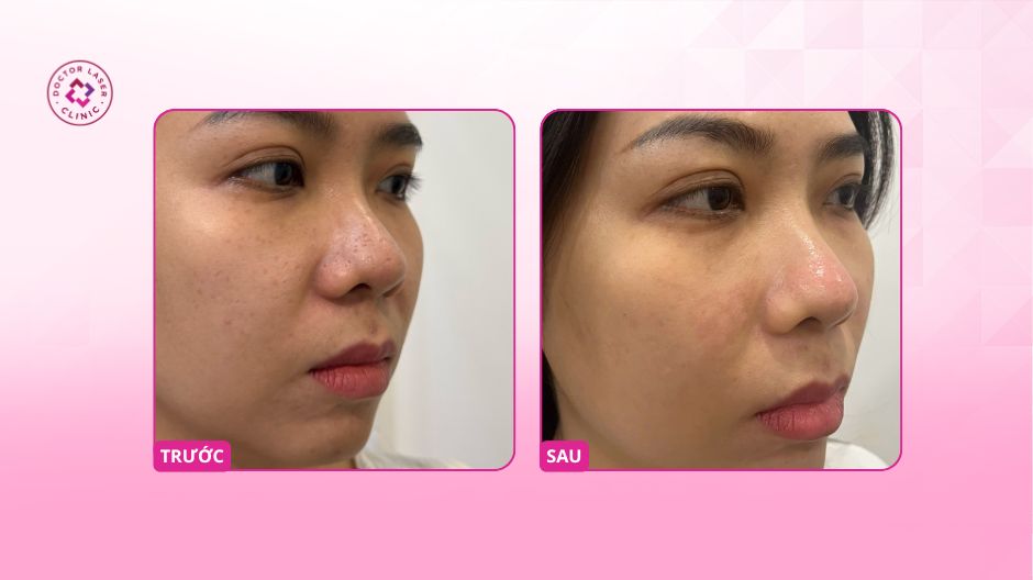 trước sau sẹo mũi đáy nhọn