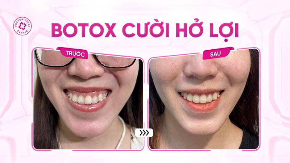 trước sau tiêm botox cười hở lợi