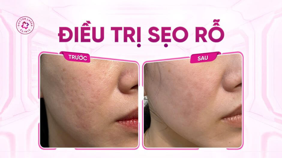 trước sau tiêm filler sẹo lõm