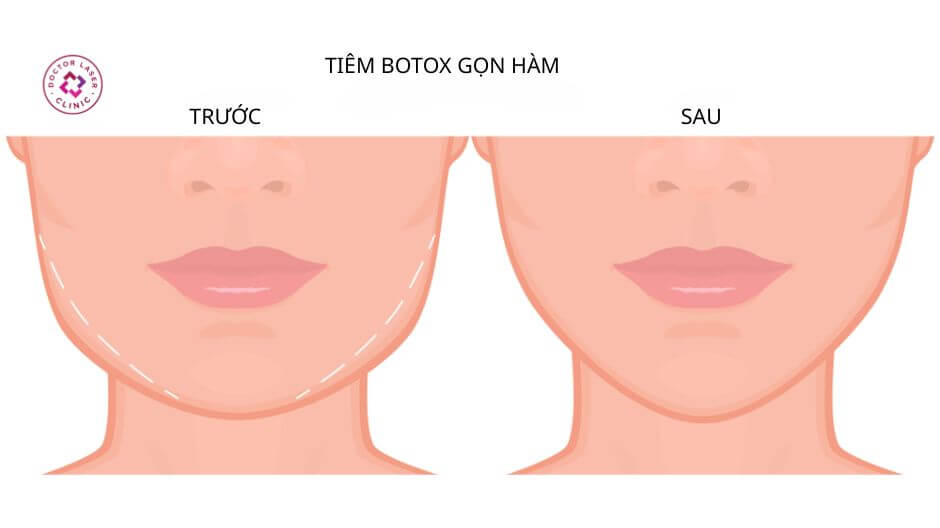 ưu điểm tiêm botox gọn hàm