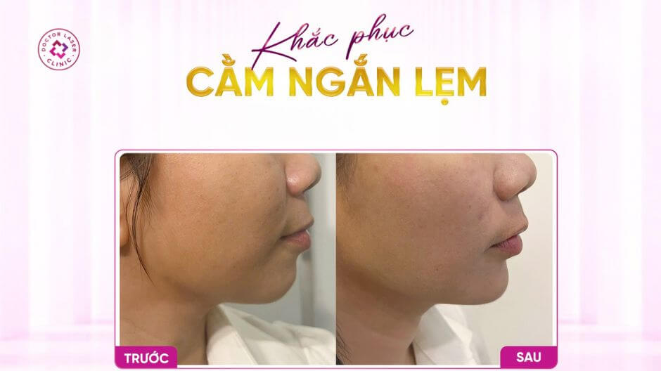 ưu điểm tiêm filler cằm