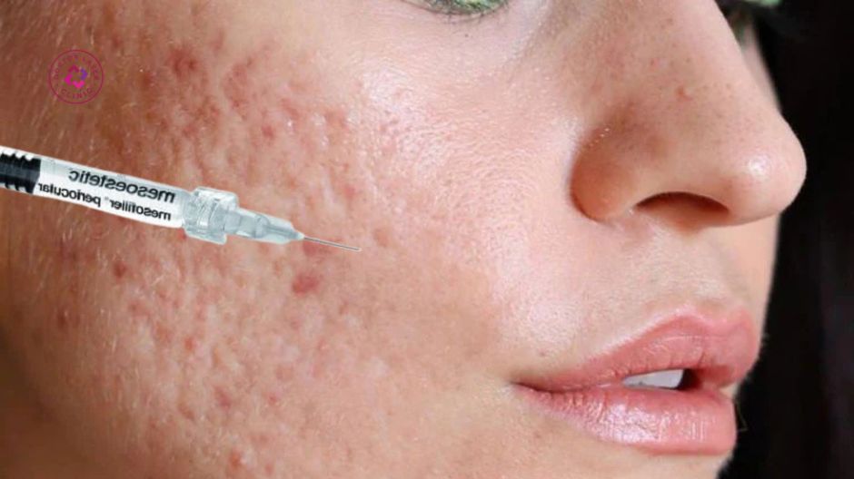 ưu điểm tiêm filler trị sẹo lõm