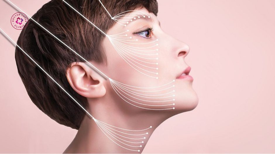 vị trí nâng cơ mặt bằng chỉ collagen