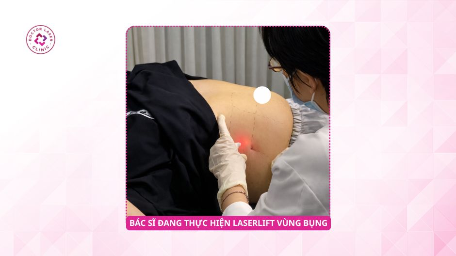 bác sĩ thực hiện laserlift vùng bụng