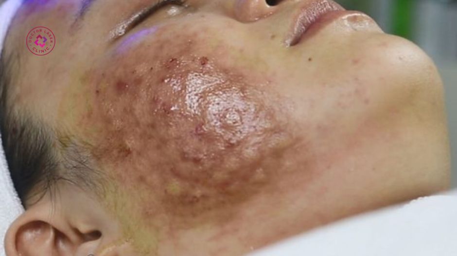 biến chứng hoại tử da sau tiêm meso