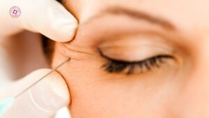 botox tác dụng khác nhau giữa người trẻ và người lớn botox tác dụng khác nhau giữa người trẻ và người lớn