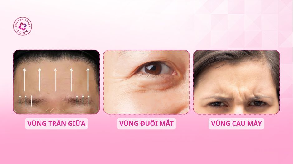 các vị trí tiêm botox xoá nhăn trán