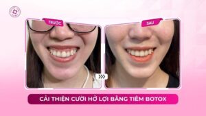 cải thiện cười hở lợi bằng tiêm botox cải thiện cười hở lợi bằng tiêm botox