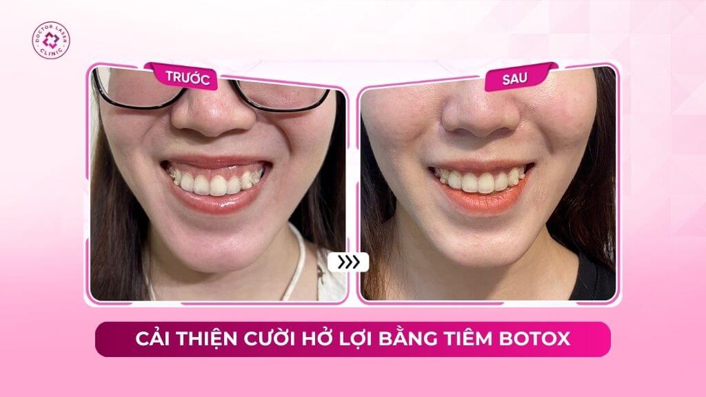 Cải thiện cười hở lợi bằng tiêm botox