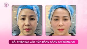 cải thiện da lão hoá bằng căng chỉ nâng cơ
