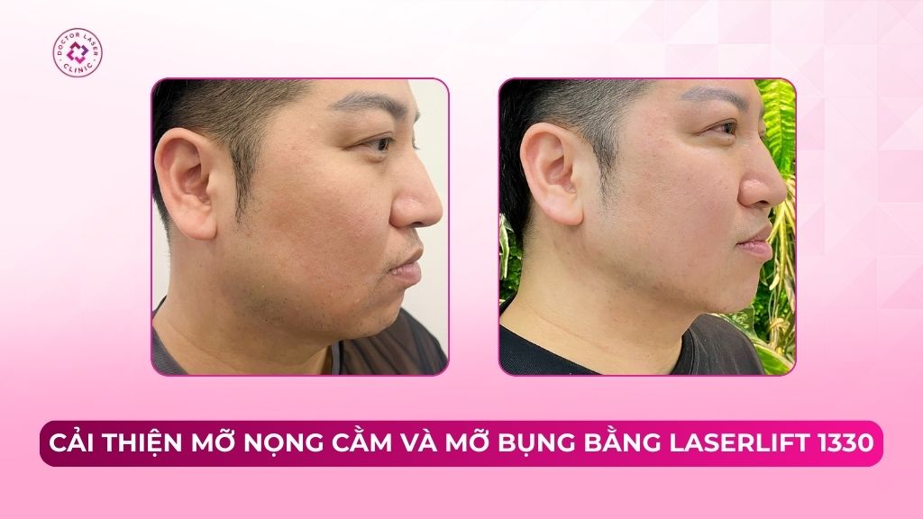 Cải thiện mỡ nọng cằm và mỡ bụng bằng Laserlift 1330