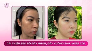 cải thiện sẹo rỗ đáy nhọn, đáy vuông sau laser co2 cải thiện sẹo rỗ đáy nhọn, đáy vuông sau laser co2