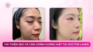 cải thiện sẹo rỗ và cân chỉnh gương mặt tại doctor laser cải thiện sẹo rỗ và cân chỉnh gương mặt tại doctor laser