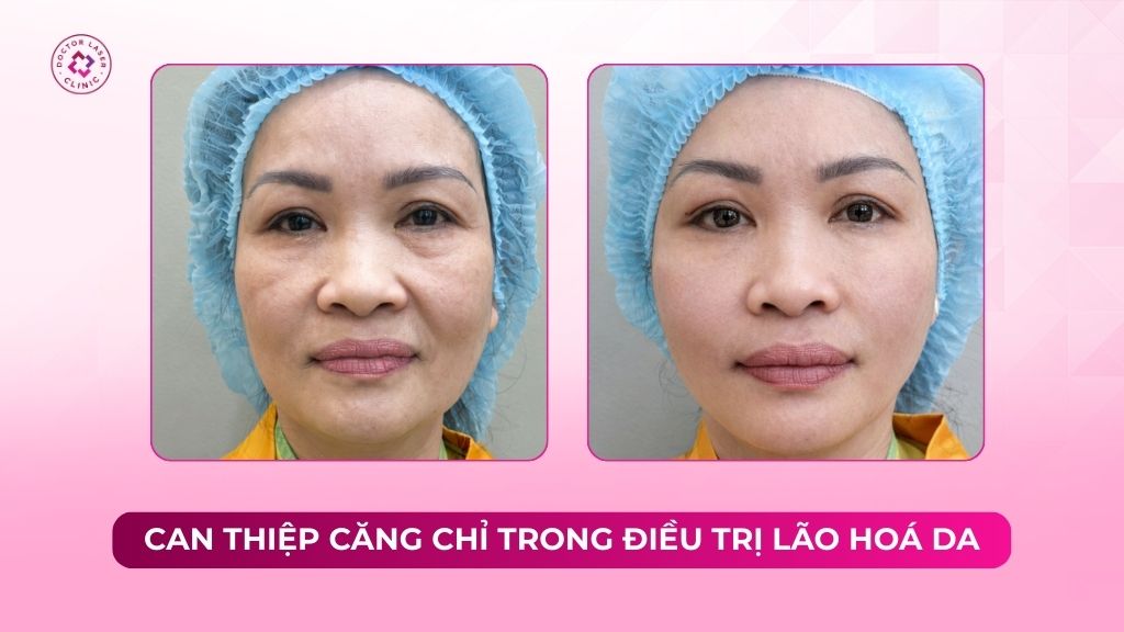 Can thiệp căng chỉ trong điều trị lão hoá da