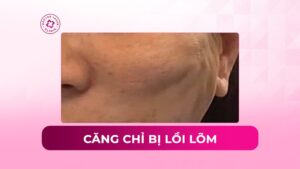 Nguyên nhân căng chỉ bị lồi lõm và biện pháp khắc phục