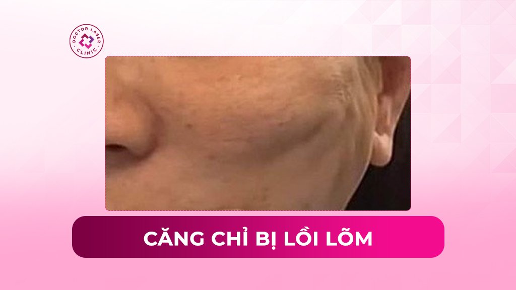 Nguyên nhân căng chỉ bị lồi lõm và biện pháp khắc phục