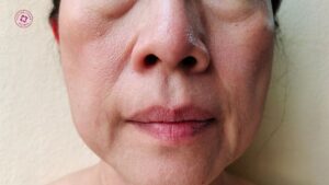 căng chỉ có làm gương mặt bị đơ cứng hoặc mất tự nhiên không căng chỉ có làm gương mặt bị đơ cứng hoặc mất tự nhiên không