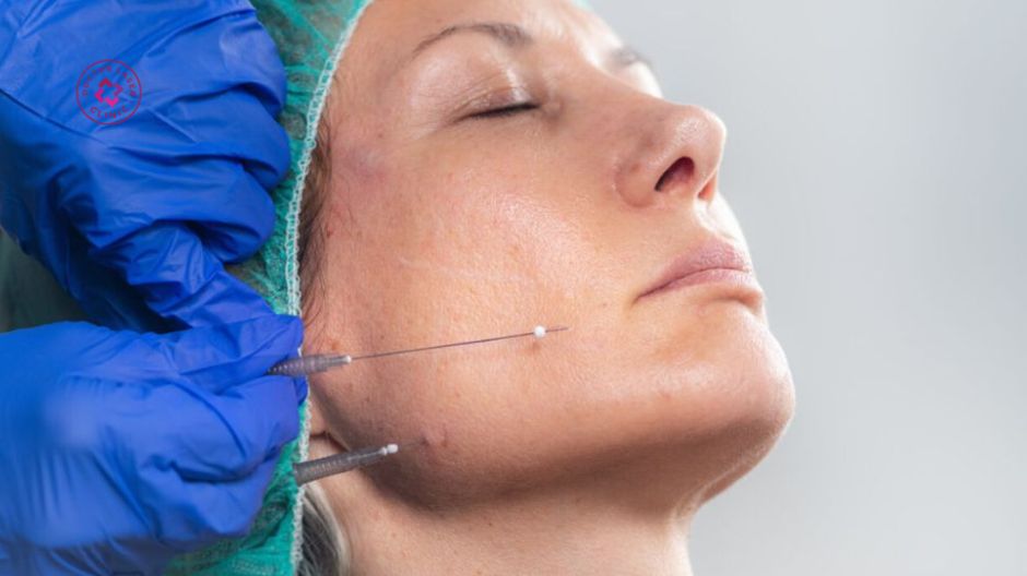 căng chỉ collagen nâng cơ trẻ hóa da