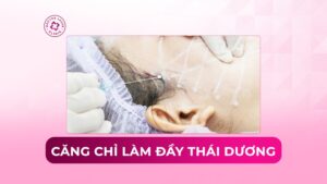 Có nên căng chỉ làm đầy thái dương không? Đánh giá rủi ro
