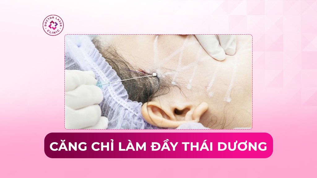Có nên căng chỉ làm đầy thái dương không? Đánh giá rủi ro