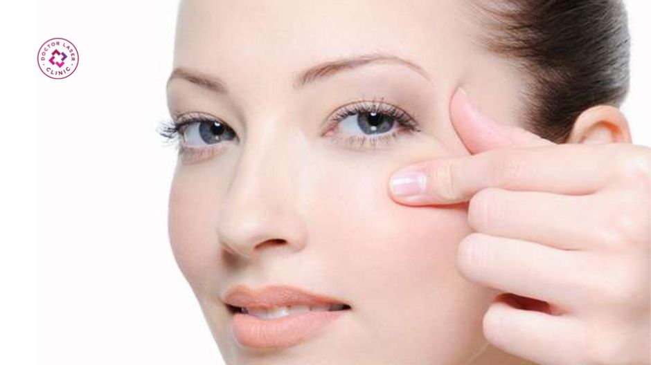 căng chỉ sinh học làm đầy thái dương