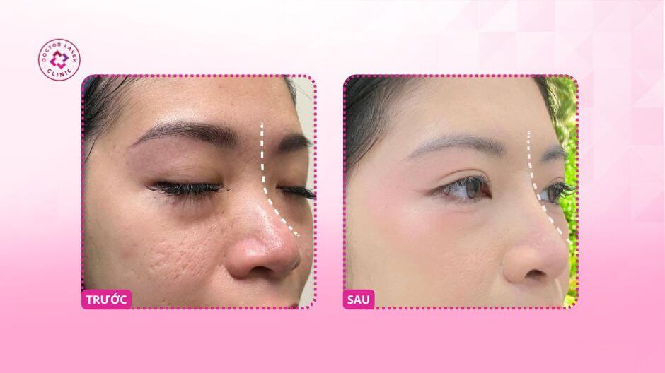 căng mũi chỉ trước sau tại doctor laser