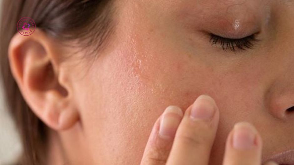 căng tức nhẹ vùng da sau tiêm meso