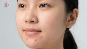 có nên trì hoãn tiêm filler khi đang bị mụn viêm hoặc da không ổn định