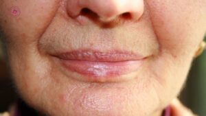 da chảy xệh nhiều căng chỉ hay phẫu thuật da chảy xệh nhiều căng chỉ hay phẫu thuật