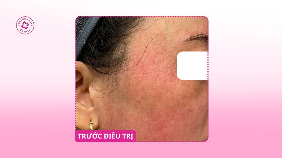 da đỏ yếu trước điều trị prp doctor laser
