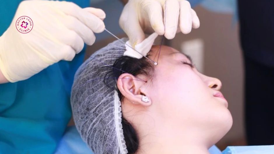 điều chỉnh lực kéo sai vector sau căng chỉ