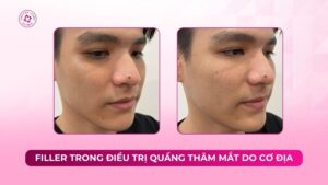 filler trong điều trị quầng thâm mắt do cơ địa filler trong điều trị quầng thâm mắt do cơ địa