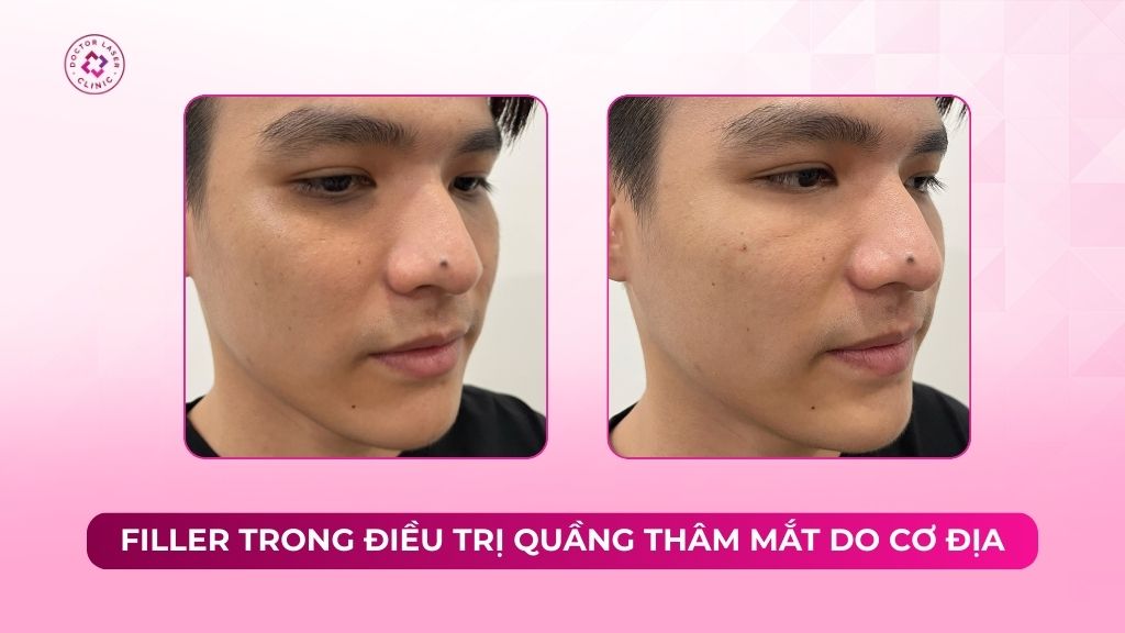 Filler trong điều trị quầng thâm mắt do cơ địa