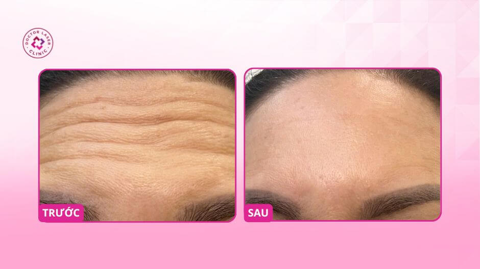 hình ảnh trước sau điều trị nhăn trán botox
