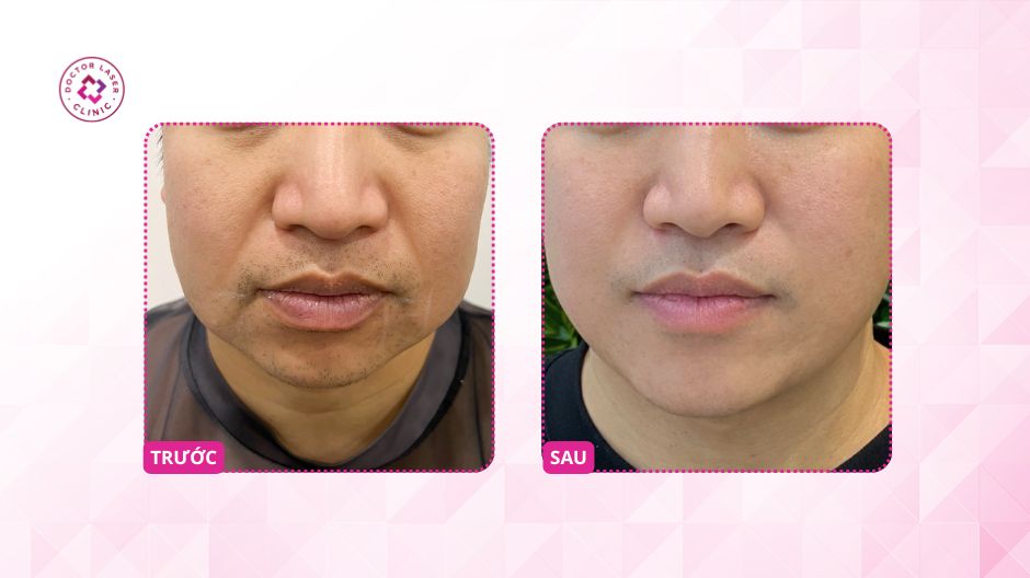 kết quả điều trị nọng cằm laserlift 1330