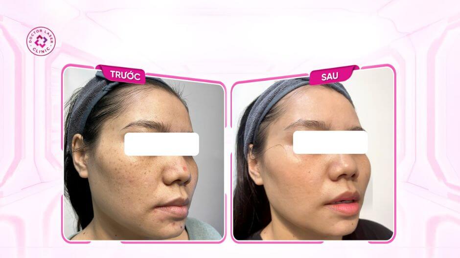 kết quả tiêm meso điều trị nám