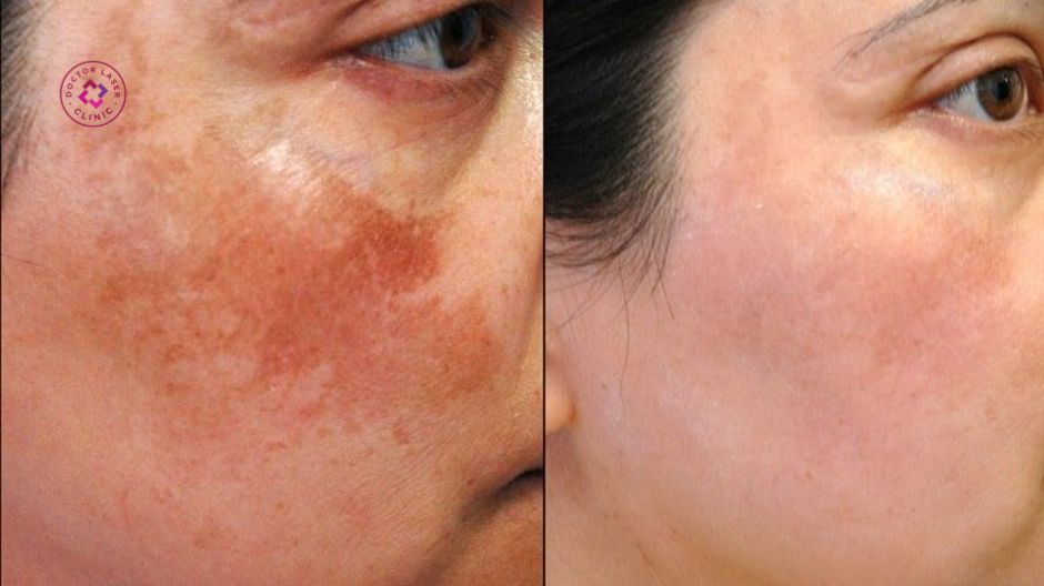 laser pico cải thiện nám tàn nhang đốm nâu