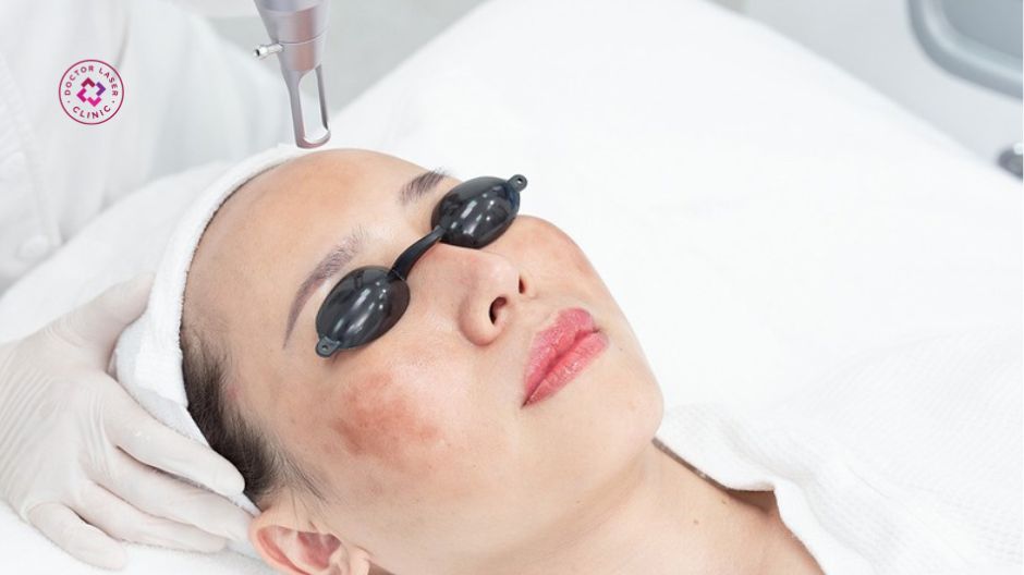 laser pico giảm nguy cơ tăng sắc tố sau viêm