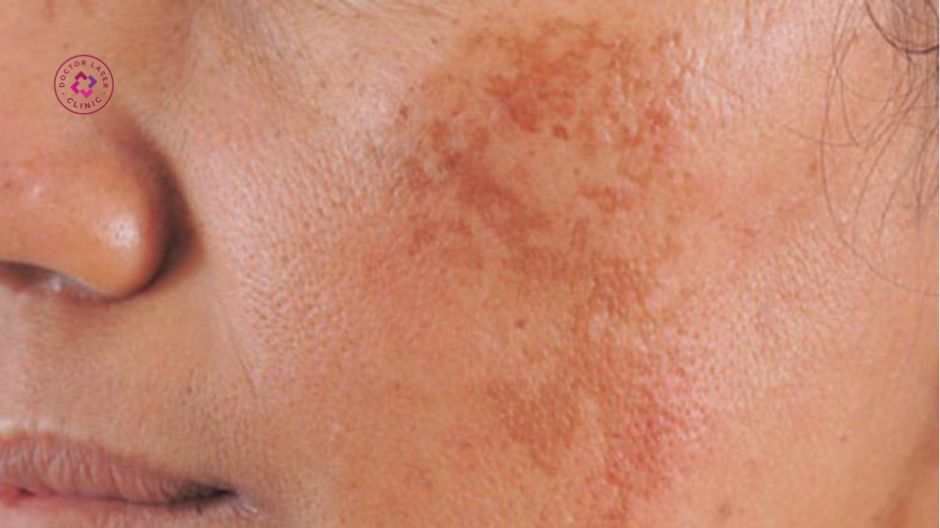 meso chỉ định nám mảng nhẹ trung bình