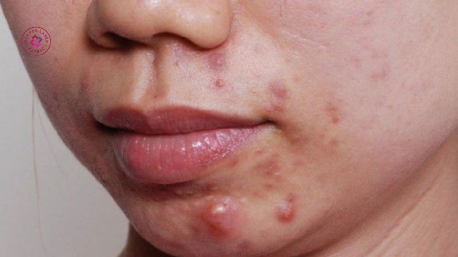 mụn bọc và mụn nang viêm để lại sẹo rỗ