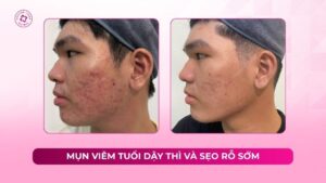 mụn viêm tuổi dậy thì và sẹo rỗ sớm