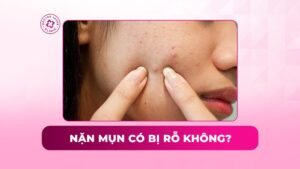 nặn mụn có bị rỗ không