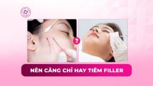 nên căng chỉ hay tiêm filler