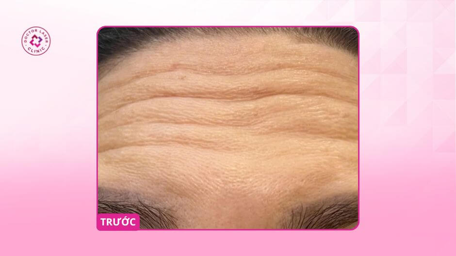 nhăn trán trước điều trị ca lâm sàng doctor laser