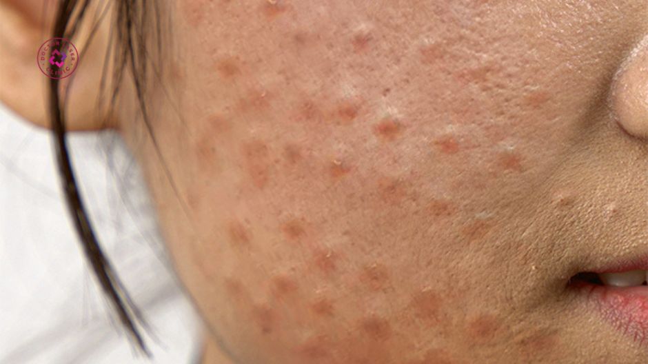 phản ứng u hạt sau tiêm meso