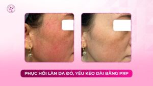phục hồi làn da đỏ yếu kéo dài bằng prp phục hồi làn da đỏ yếu kéo dài bằng prp