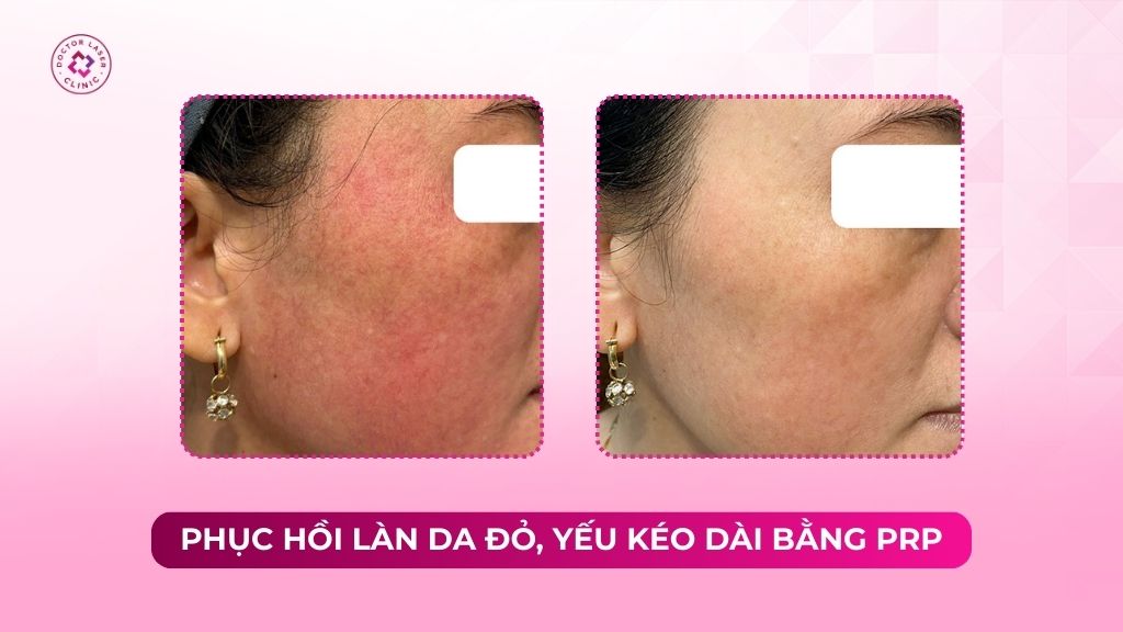 Phục hồi làn da đỏ yếu kéo dài bằng PRP